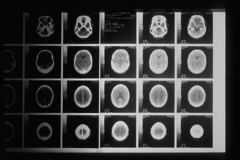 Grid of axial CT brain scans showing cross-sectional slices of a human head from top to bottom
