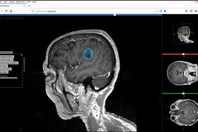 Medical imaging software showing a sagittal brain scan with a highlighted brain tumor region and segmentation tools