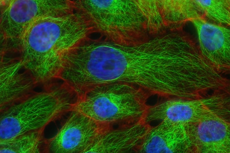 Fluorescence microscopy image of human breast cancer cells showing blue nuclei, green cytoskeletal fibers, and red cellular structures