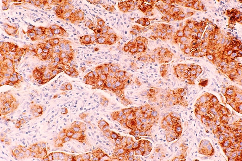 Microscopic view of stained cancer tissue sample